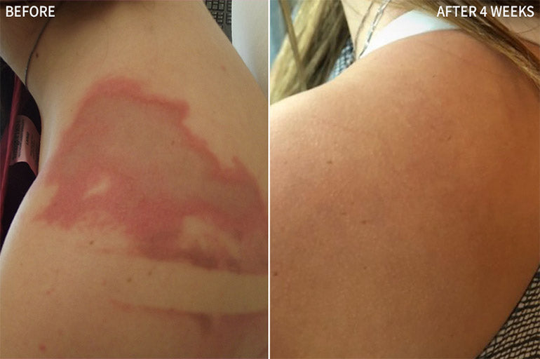 Treat Scars and Skin Discoloration