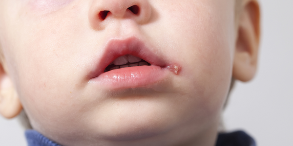 Toddler with cold sore in the corner of their mouth.