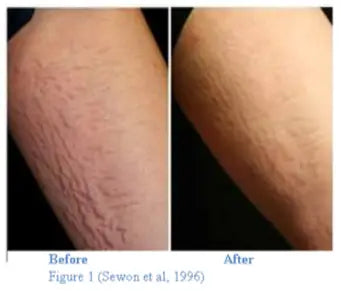 Stretch Mark Therapy: Ineffective Treatments & Need for More Research2