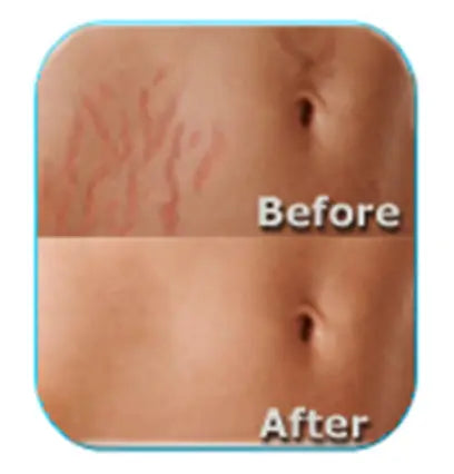 Stretch Mark Therapy: Ineffective Treatments & Need for More Research