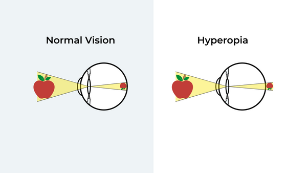 hyperopia