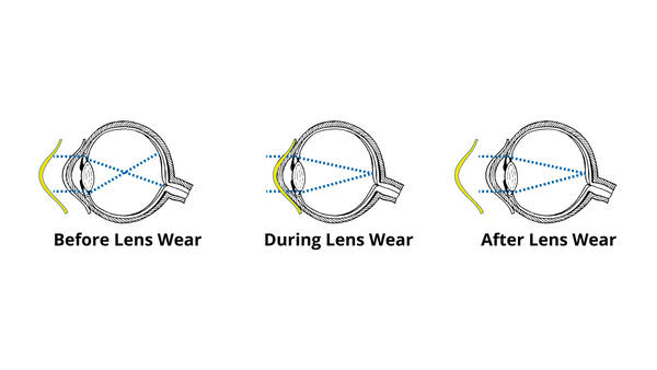 Orthokeratology 