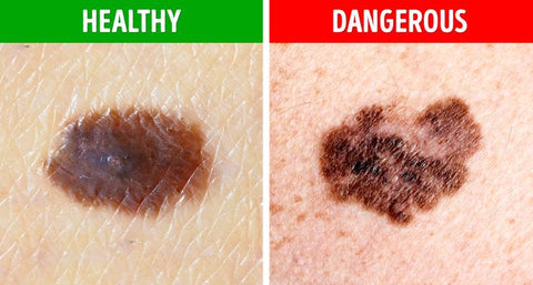 Health - Dangerous Moles