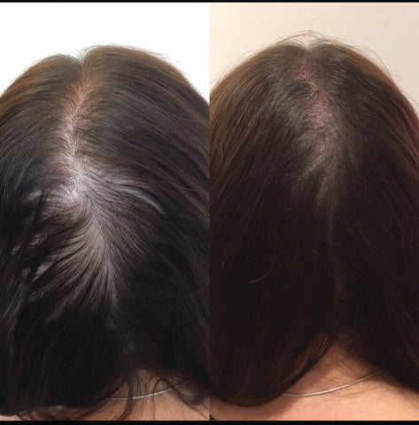 female hair loss scalp micropigmentation treatment