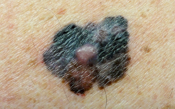 Melanoma: The deadliest form of skin cancer