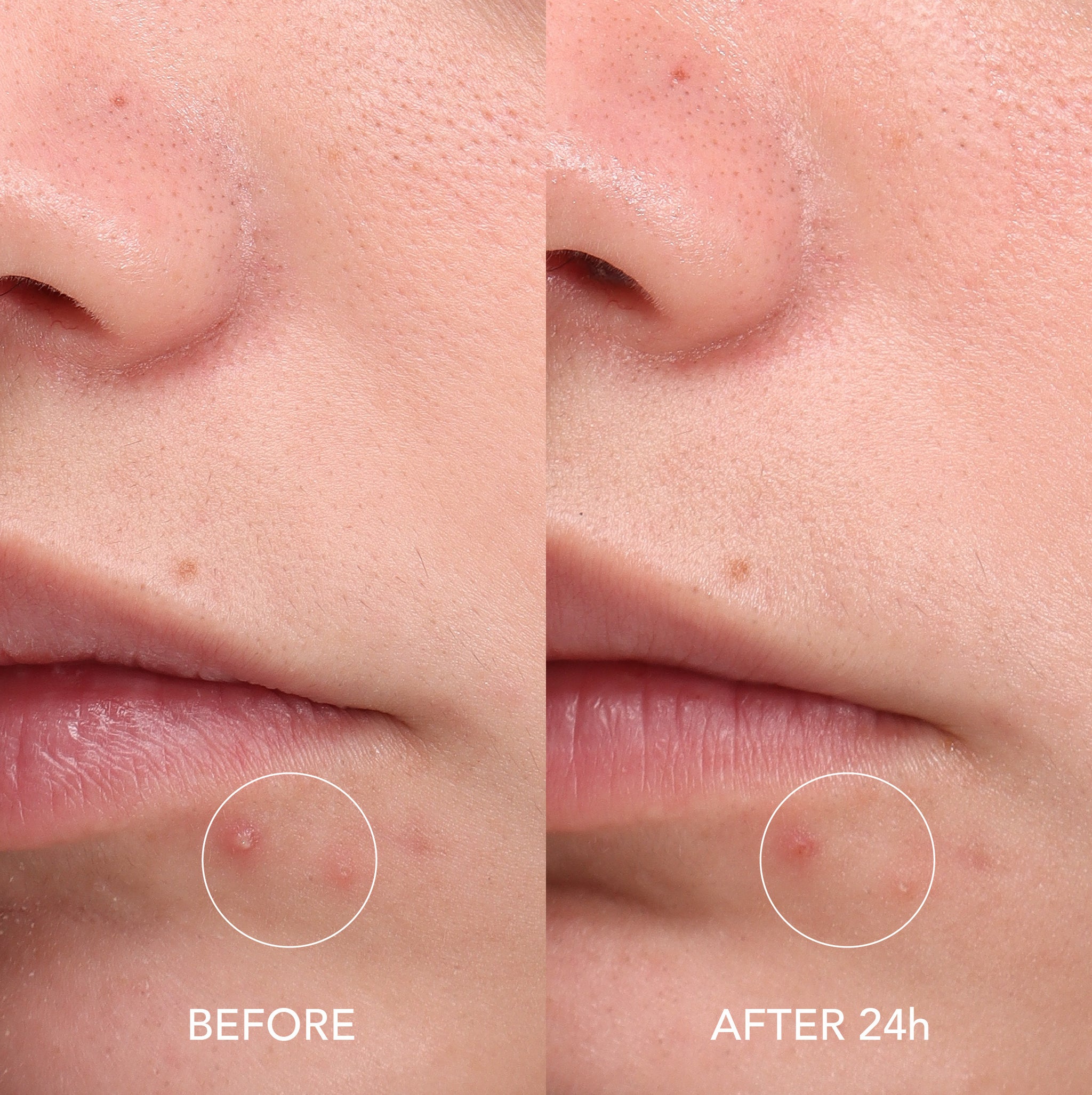 WEB_IMAGEN B&A PIMPLE PATCHES-07 (1).jpg__PID:7ac92c1e-295d-4d58-a159-93c2ca47b64a