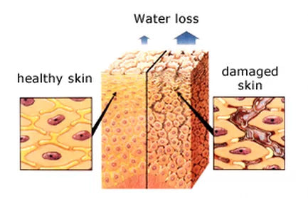 Healthy and Demaged Skin