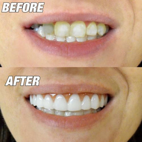 veneers teeth