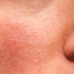 Mikrobiom der Haut Rosacea