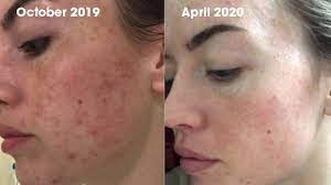 An image showing a before and after comparison of a person's skin, with the 'before' image dated October 2019 showing visible acne and redness, and the 'after' image dated April 2020 displaying a clear improvement with reduced acne and clearer skin tone, presumably following the use of topical probiotics.