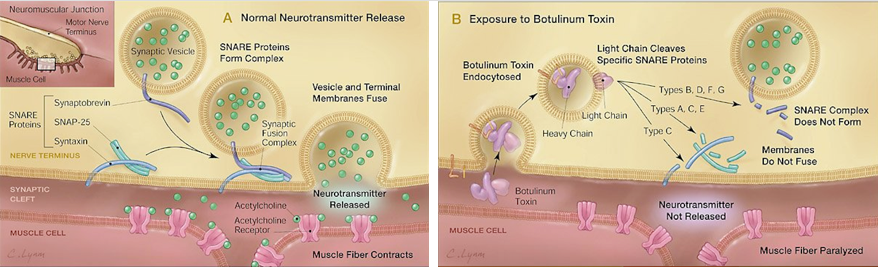 First top Figure shows how Botox works as applied by our medical professionals. It describes how normal neurotransmetters are released into the synaptic cleft of our muscle cells. Second bottom Figure shows how Botox works as applied by our medical professionals and it describes Botulinum toxin's effects. It describes how normal neurotransmetters are released into the synaptic cleft of our muscle cells followed by encapsulation of the toxin into vesicles with heavy and light chains released.