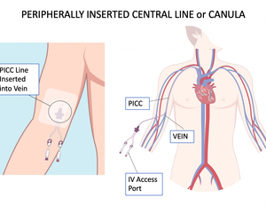 Pripherally Inserted Central Line or Canula for our IV Therapy Procedure
