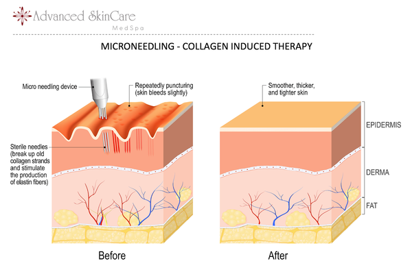 Advanced Skin Care microneedling figure showing how a microneedling device induces collagen formation. These sterile needles moves old collagen strands and stimulates the production of elastin fibers to fill into the voids that create irregularities on the skin's surface. The treatment then allows the skin to rejuvenate into smoother, thicker, and tighter skin on the epidermis level.