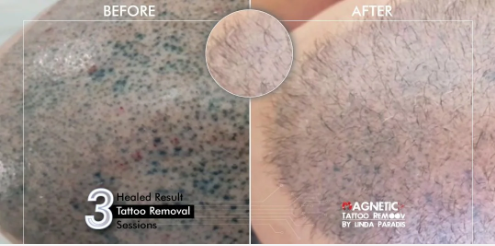 Magnetic tattoo removal used to remove tattoo from the top of the head (the scalp), picture shows before and after pictures of the scalp where the after picture looks like a natural bald head.