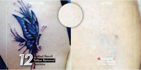 Magnetic body tattoo removal before and after pictures. The tattoo located on the arm of the patient is dark blue and the magnetic tattoo removal technique works fantastically well.