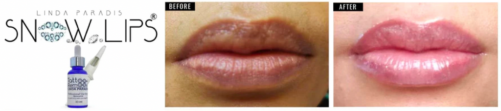 Beautiful lips after pigmentation lightening using our magnetic tattoo removal technique, before and after.