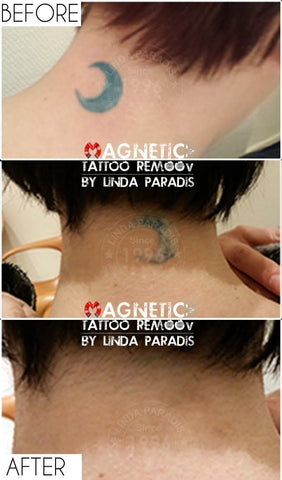 Before and After tattoo removal from neck using our magnetic tattoo removal tecnique. Before and after pictures show how natural the skin looks after the treatment and the tattoo is fully removed.