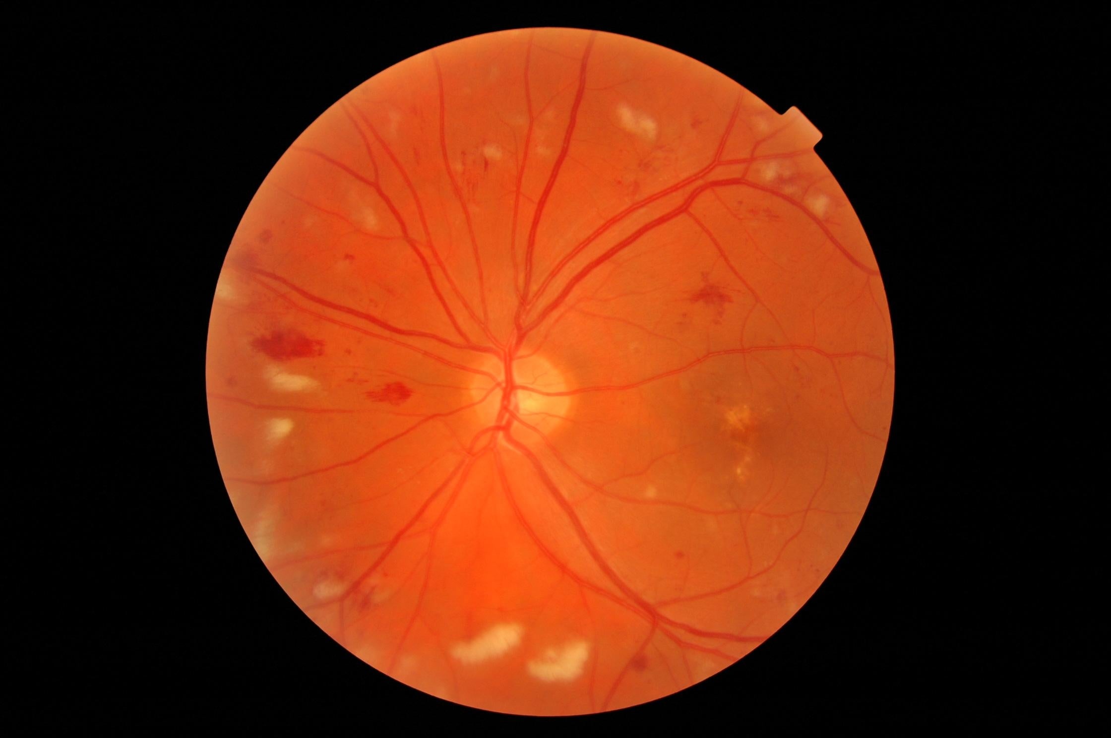 Diabetic Retinopathy hero image