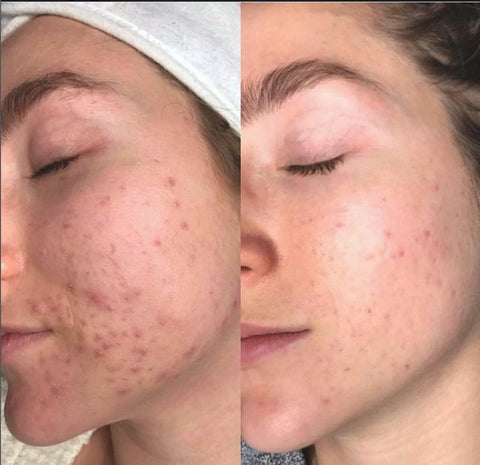 before and after yonka skin care for acne