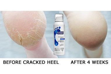 footlogix cracked heel