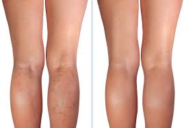 before and after laser leg vein treatment