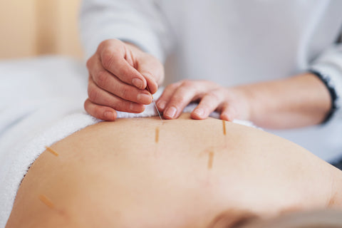 Acupuncture for back pain relief