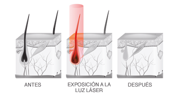 depilación láser comportamiento del vello