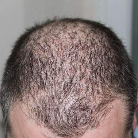 Natural Treatment for Alopecia BM63 30mL