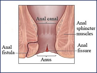 Natural Remedy for Fistula in Ano (BM133)