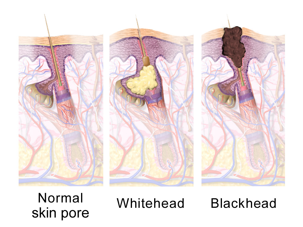 Normal skin pore, whitehead, and blackhead.