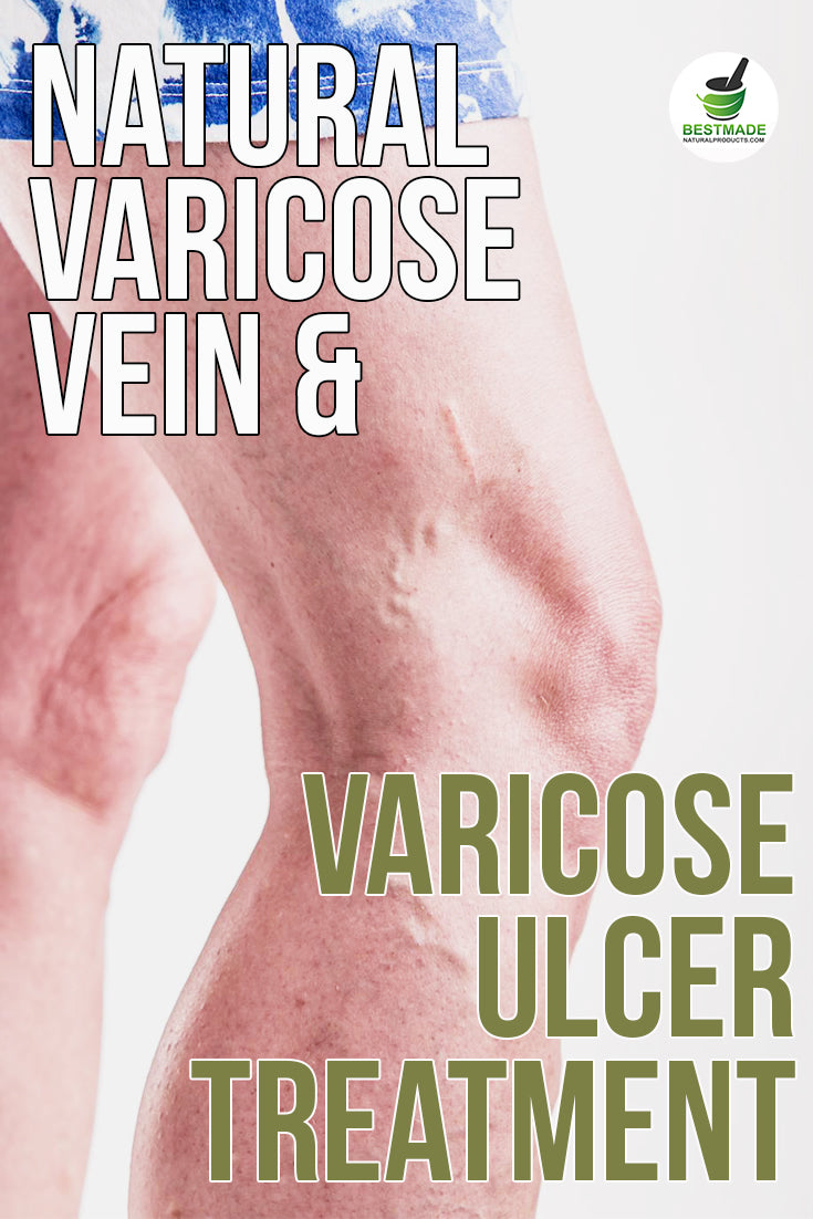 Varicose Veins and Varicose Ulcer Remedy (BM31)