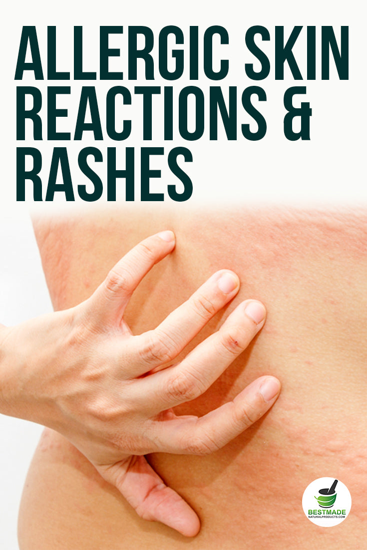 Allergic Reactions & Skin Rashes BM39 (30mL)