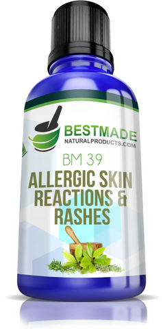 Allergic skin reaction and rashes remedy.