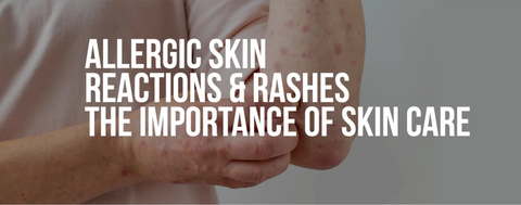 Allergic Reactions & Skin Rashes BM39 (30mL)