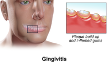 Natural Remedy for Gingivitis Bio18 300 Pellets