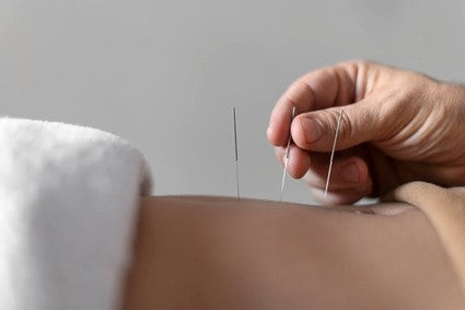 Acupuncture practice.