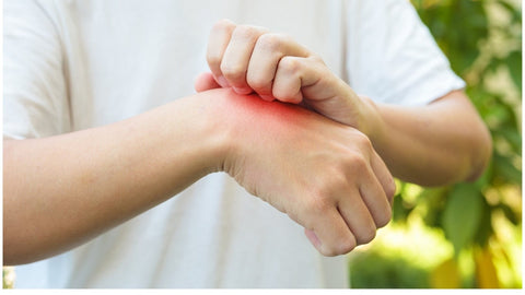 Person with itchy insect bite on hand