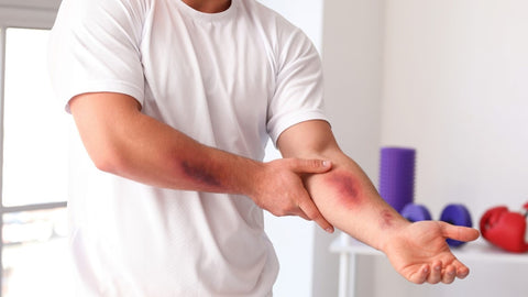 Man with bruises on his arms