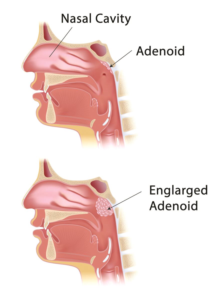 Natural Remedy Adentis (Enlarged Adenoids) BM96, 30mL
