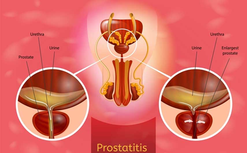 Prostatitis Natural Remedy & Supplement BM126