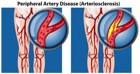 Graphic representation of peripheral artery disease (arteriosclerosis)