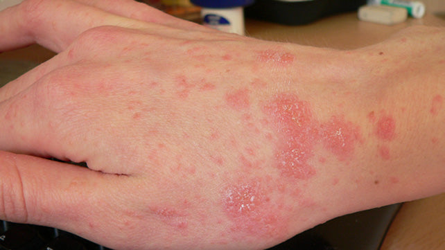 pimple-like rash on hand
