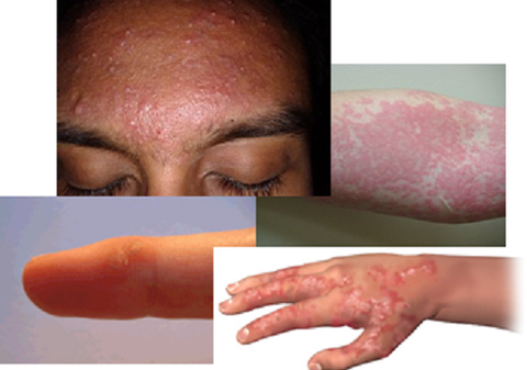 Psoriasis & Skin Disorders Natural Remedy (BM7)