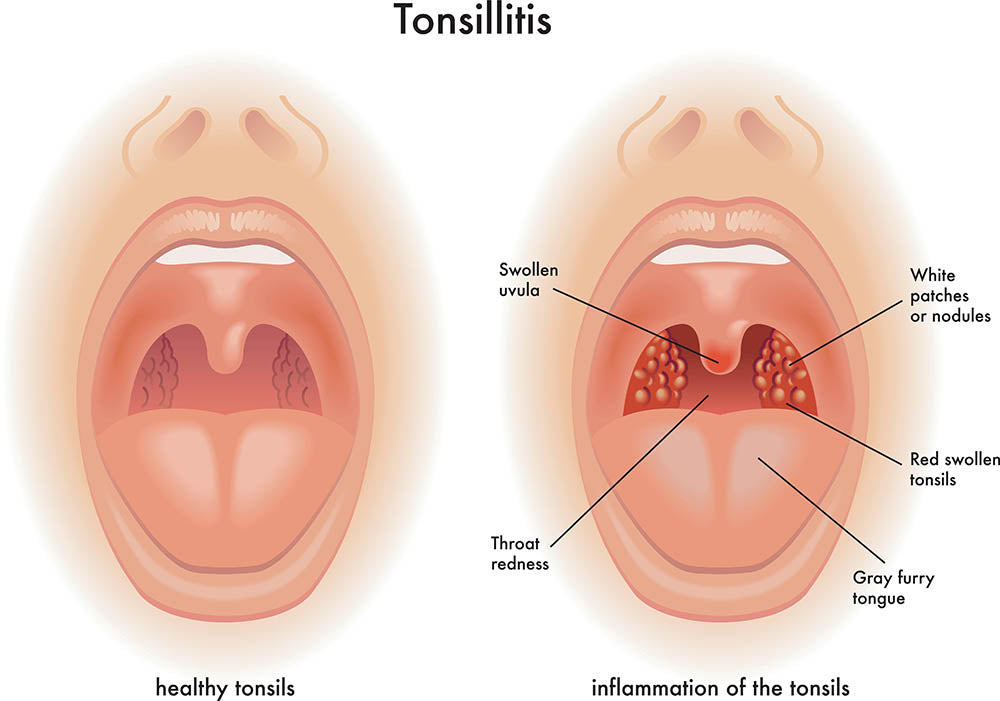 Tonsillitis