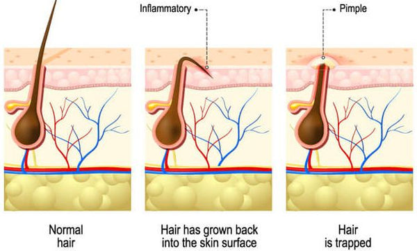 What causes ingrown hair