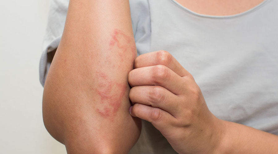 how to heal eczema