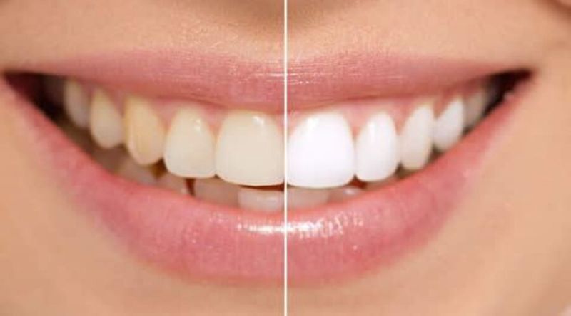 teeth whitening at home