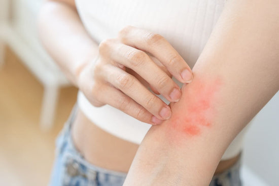 How to get rid of eczema