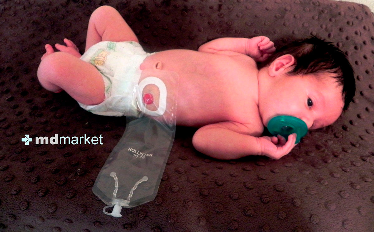 Bebé ostomizado aspectos que debes saber sobre los estomas neonatales y pediátricos: Mdmarket