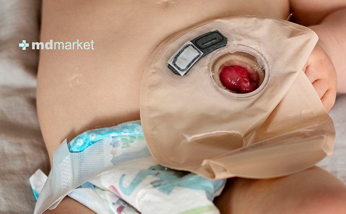 Bebé ostomizado con bolsa de ostomía: Mdmarket